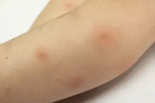 mite bites on humans face