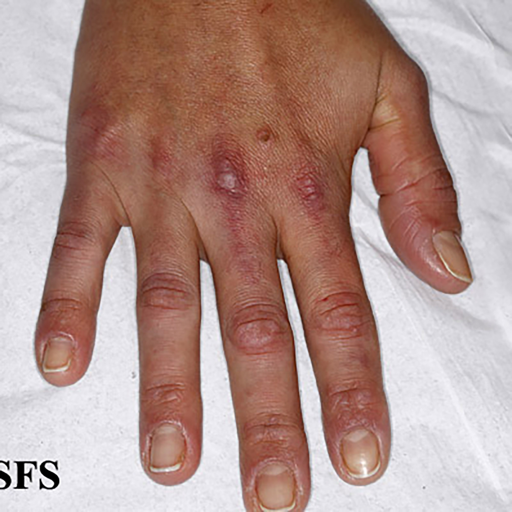 Pakistan Rash 62 Psoriatic Arthritis Elbow Rash