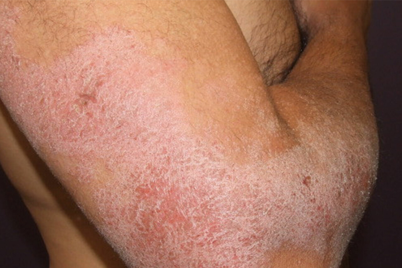 Heat Rash or Prickly Heat (Miliaria Rubra) Condition, Treatments and  Pictures for Children - Skinsight