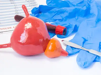 带前列腺的膀胱模型靠近手术刀、手术手套和带血检结果的血液试管。手术或外科手术指征
