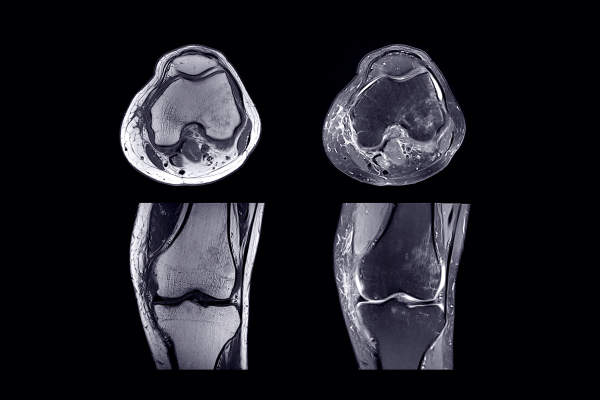 膝关节MRI