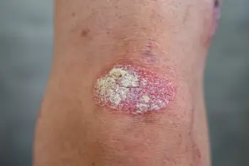 A view of psoriasis on a knee