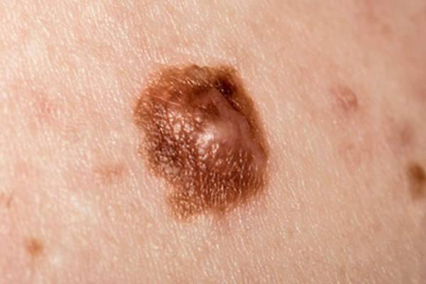Suspicious Mole Abnormal Color