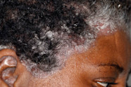 Pictures Of Sores And Scabs On Scalp Causes And More 59 OFF