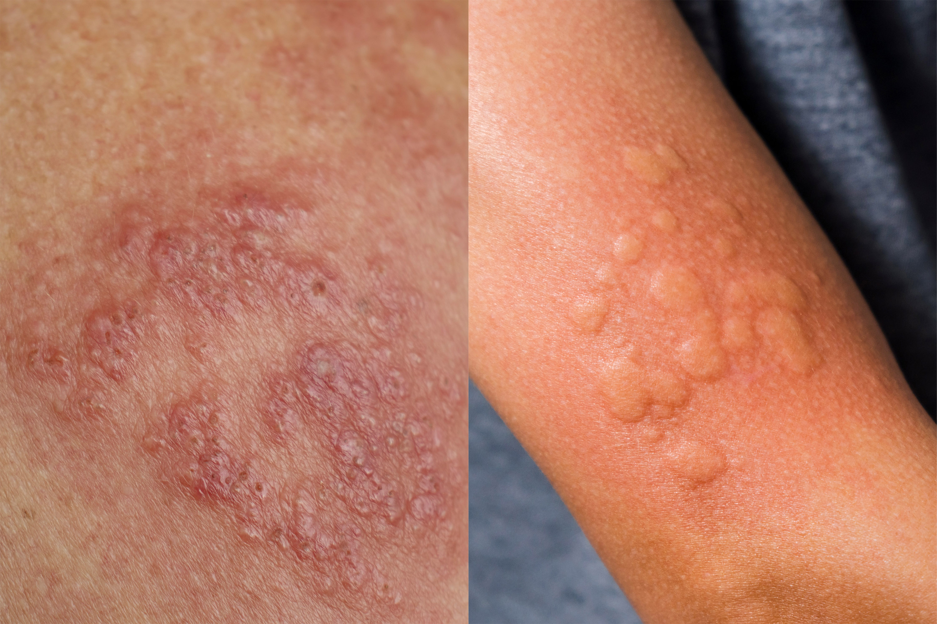 Hives vs. Eczema How to Tell the Difference