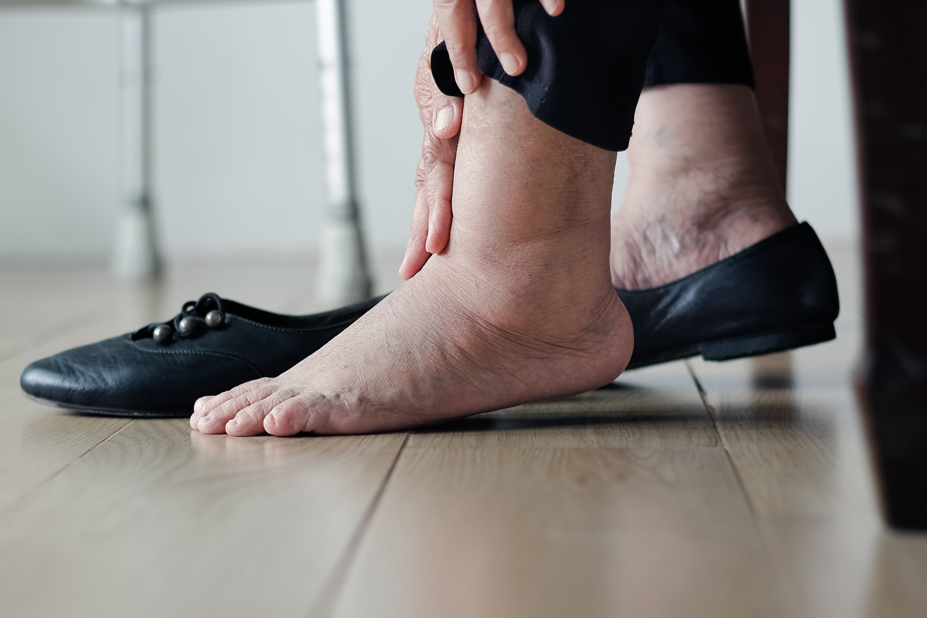 Heart failure and swollen feet: Link, treatment, and more