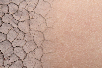 Eczema Flare-Ups: How To Manage Them | HealthCentral