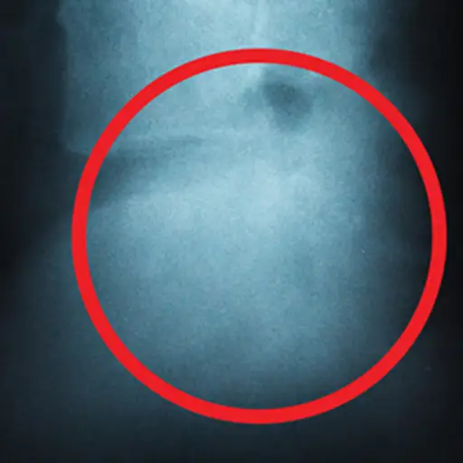椎骨的x射线。
