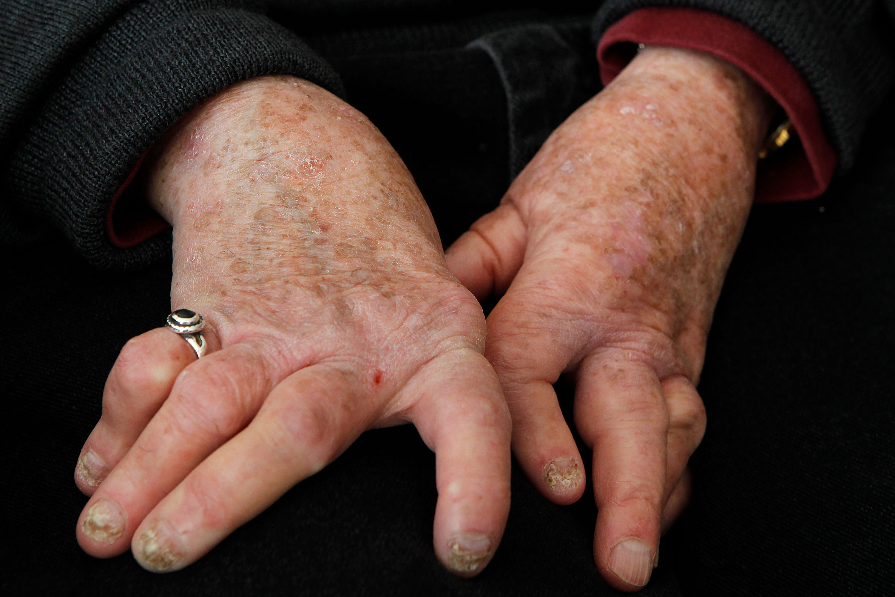 Psoriatic Arthritis Hand Deformity GettyImages 1408717276 3000x2000 