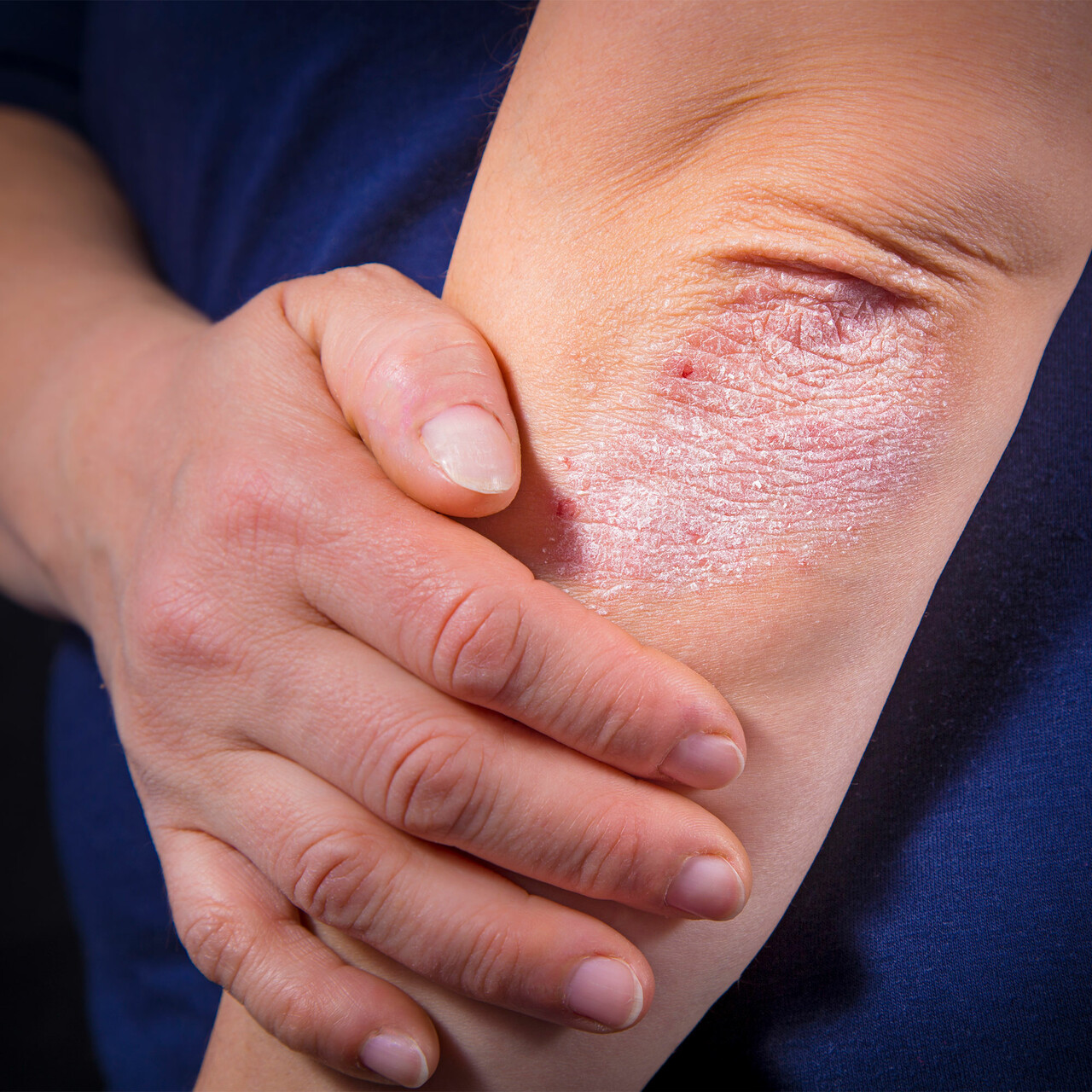 牛皮癣的特写视图肘部