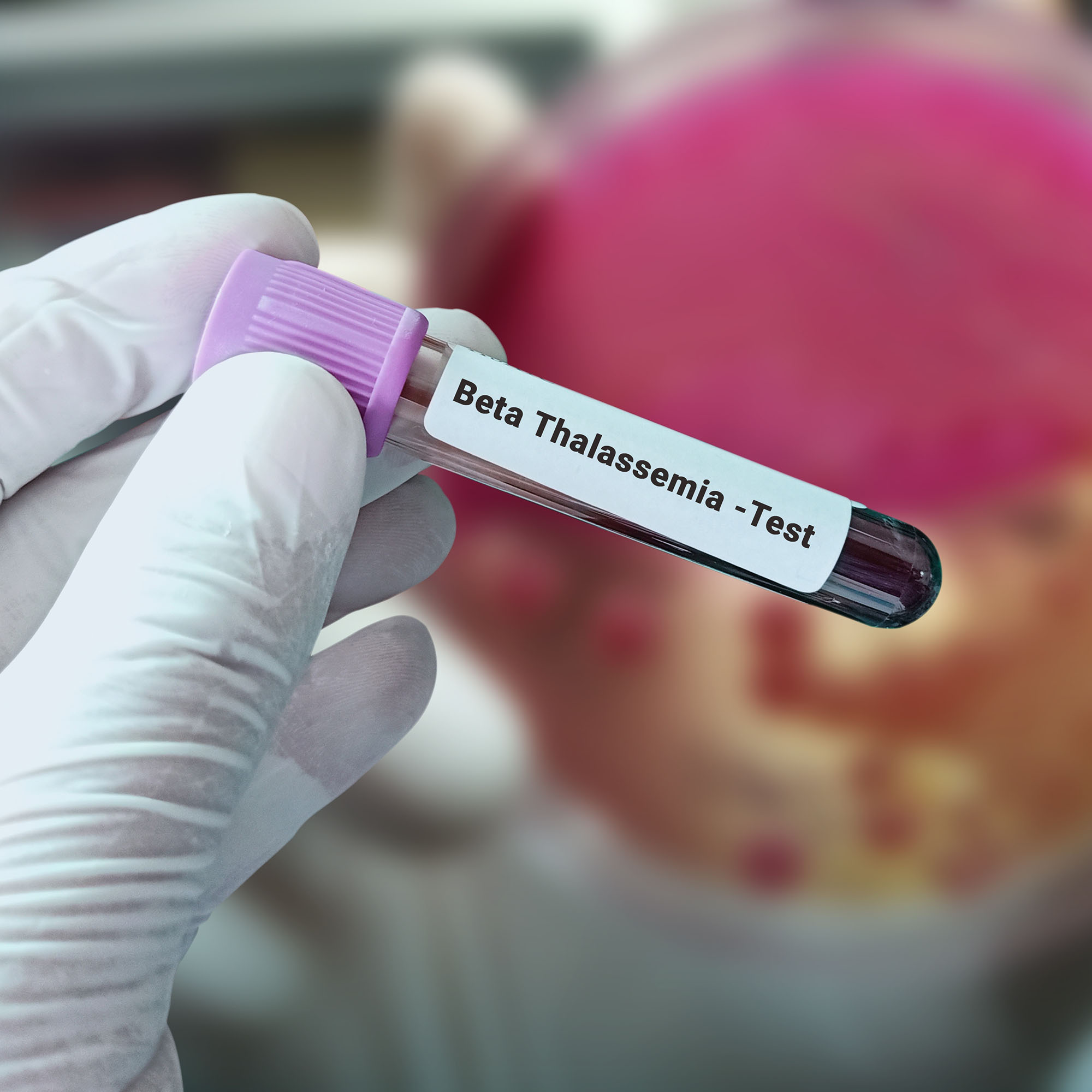 Understanding Beta Thalassemia Severity