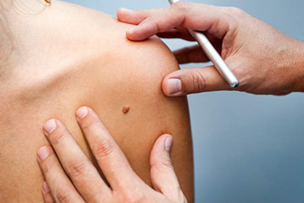 皮肤科医生检查病人的痣。