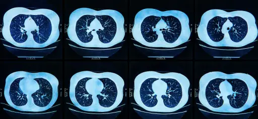 扫描肺