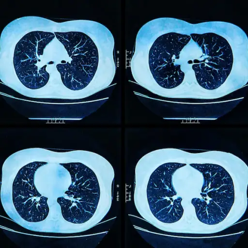 肺扫描