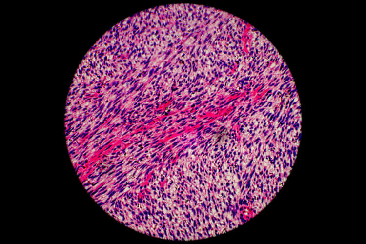显微镜下的人纤维肉瘤癌细胞