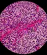 显微镜下的人类纤维肉瘤细胞