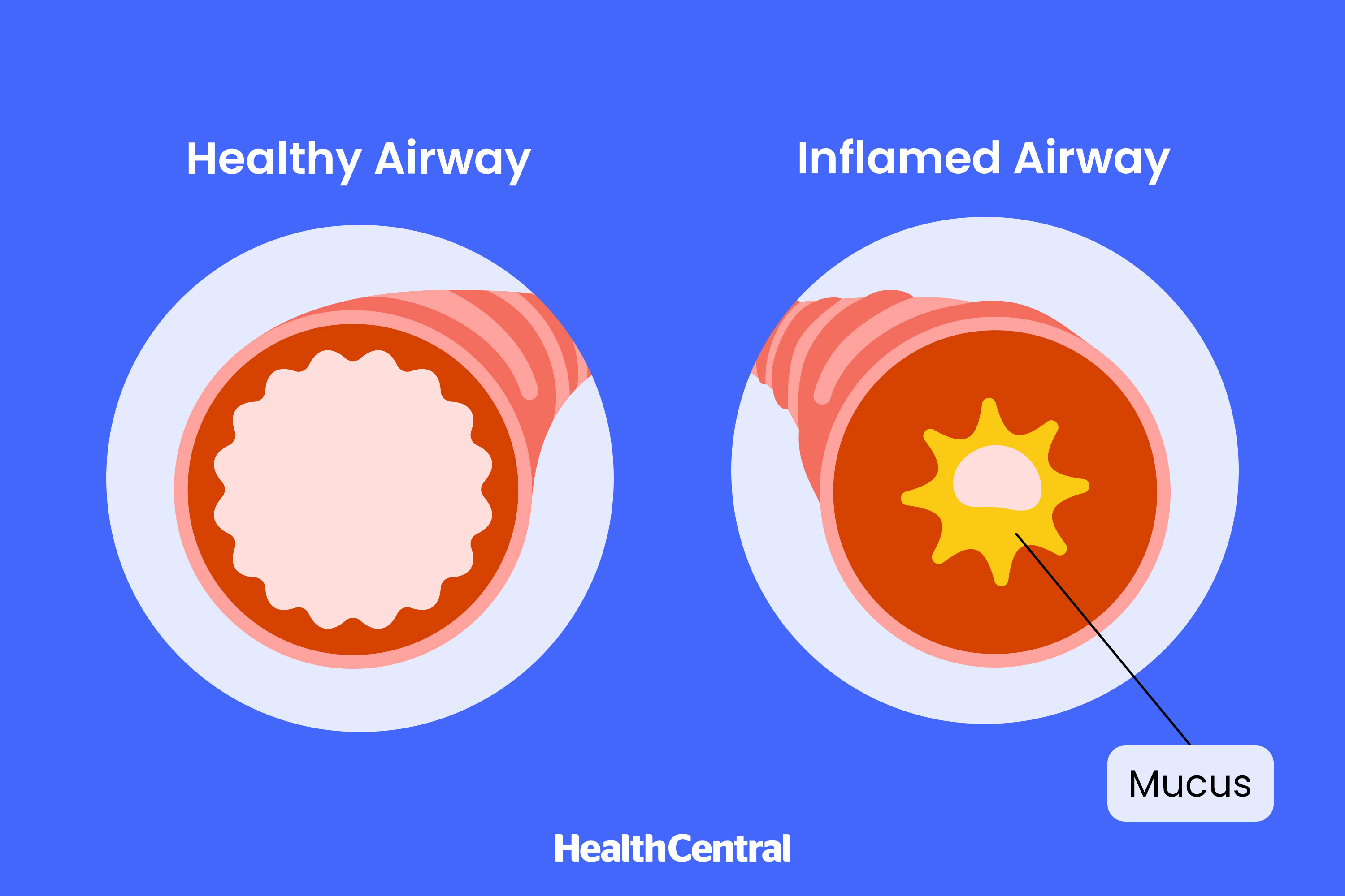 A graphic comparing a healthy airway and an inflamed airway