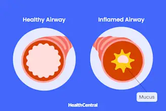 A graphic comparing a healthy airway and an inflamed airway