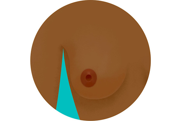 乳头倒置示意图