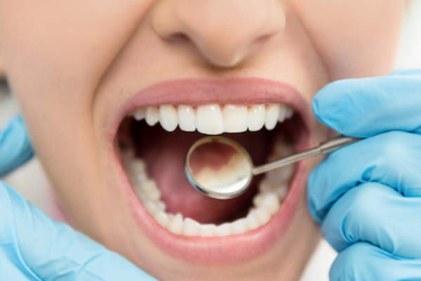 医生用牙科镜看口腔