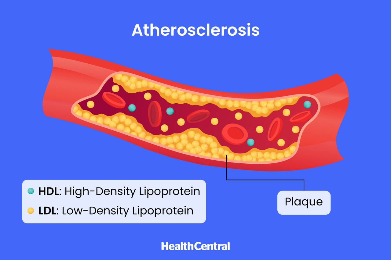 High LDL Cholesterol and Heart Health: Visual Guide to Risks