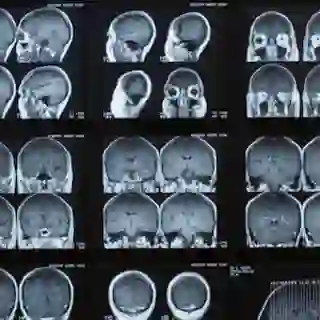 MRI scans of brain