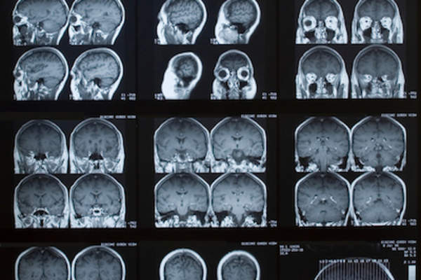 大脑核磁共振扫描