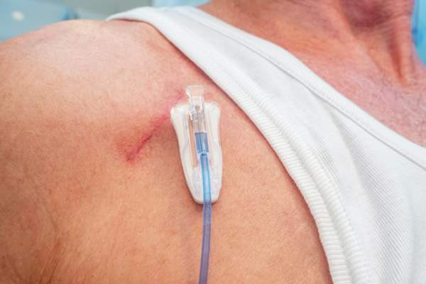 chemo port