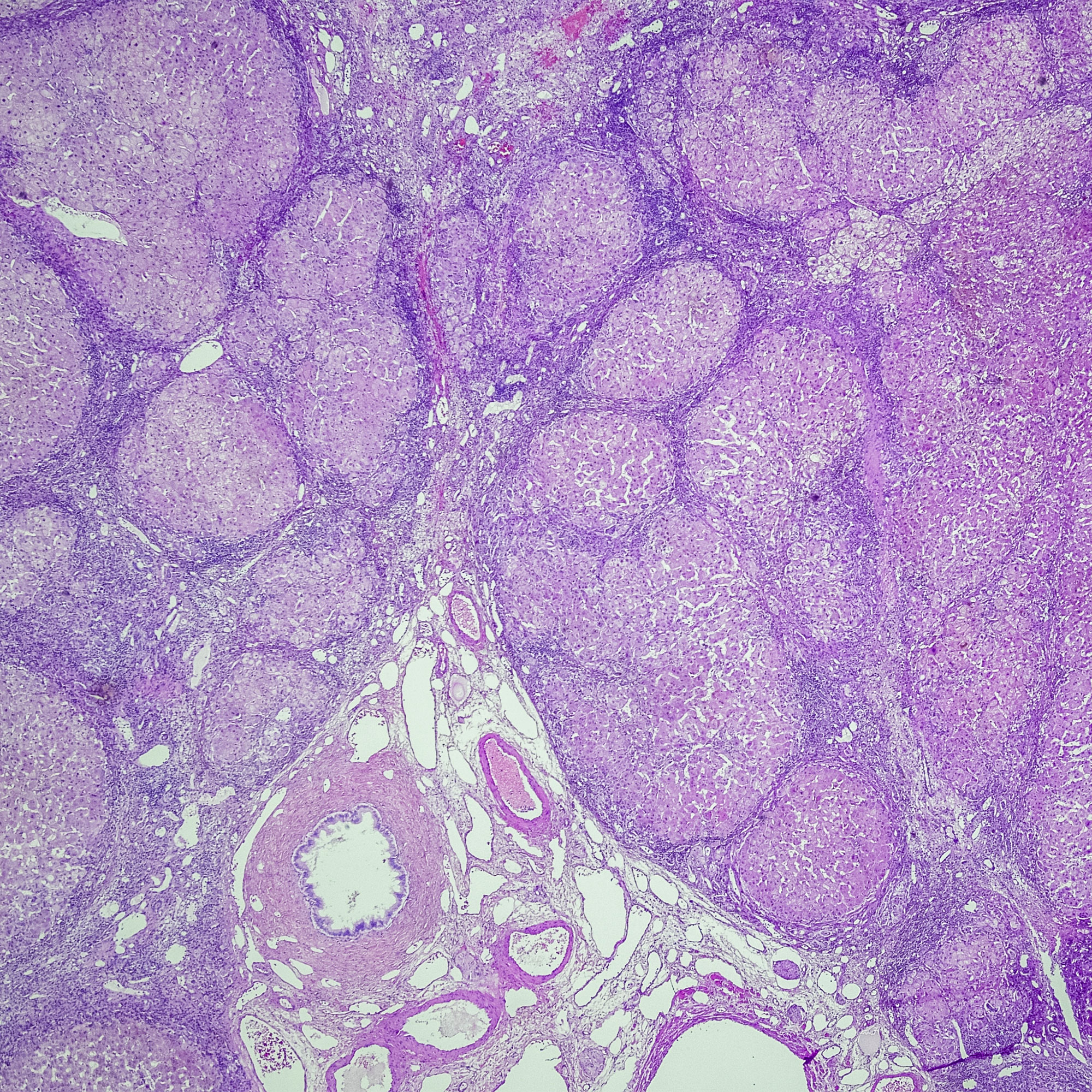 肝炎影响的肝脏的微观视图