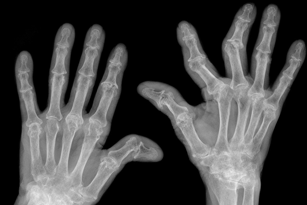 rheumatoid arthritis a kezén)