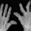 An x-ray showing hands with advanced rheumatoid arthritis