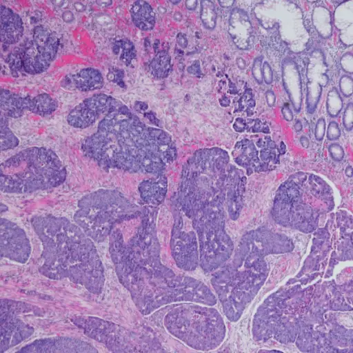 结肠腺癌的显微照片