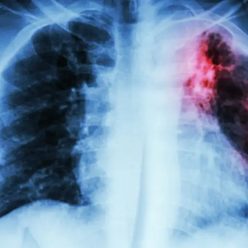肺结核X射线。