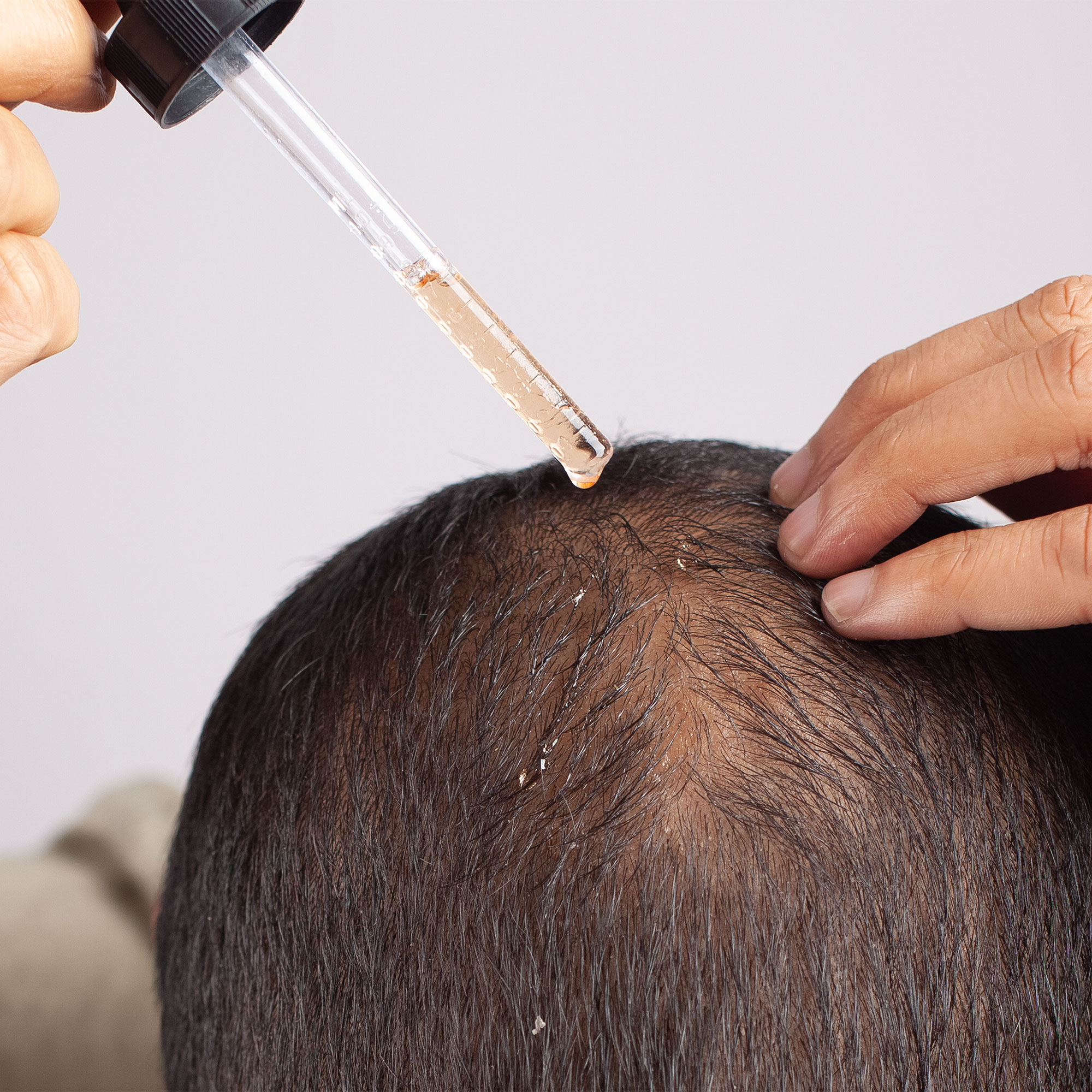 This Is How Alopecia Treatment Works