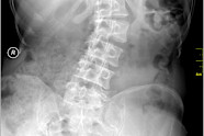 Can Scoliosis Cause Uneven Hips 