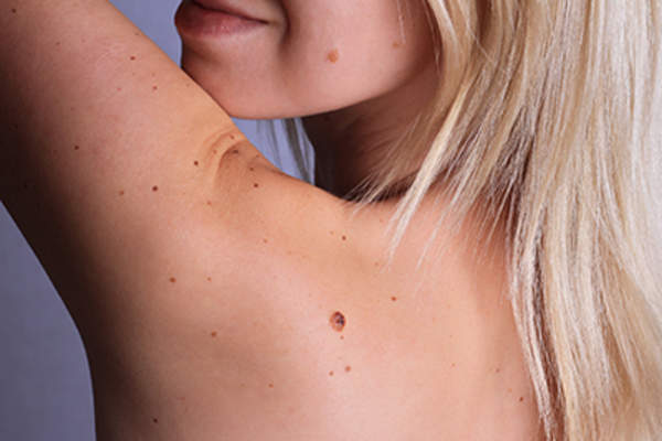 在她的胎记女人背部和脸。