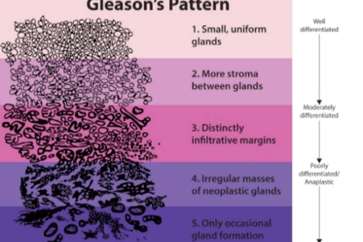 什么是Gleason评分