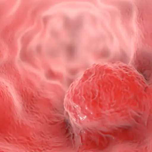Gastroesophageal Junction Cancers What You Should Know Gastroesophageal Junction Cancers What You Should Know