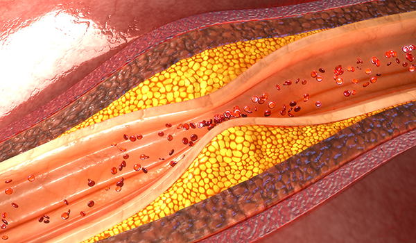 What Is “LDL Pattern B”? - Cholesterol