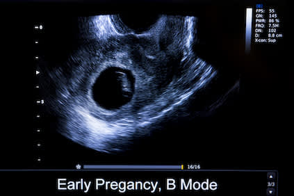 孕早期超声图像