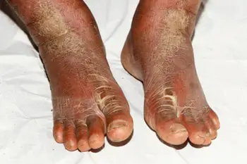 A view of psoriasis on feet