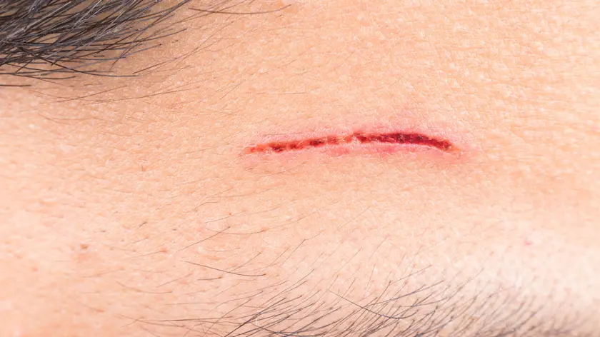 How To Care For Open Wounds