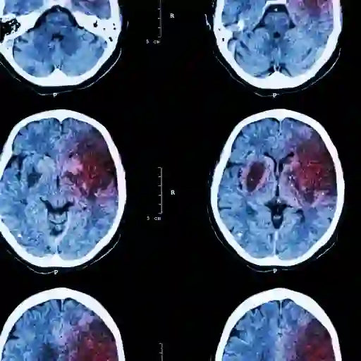 一个视图的脑部扫描显示缺血性中风