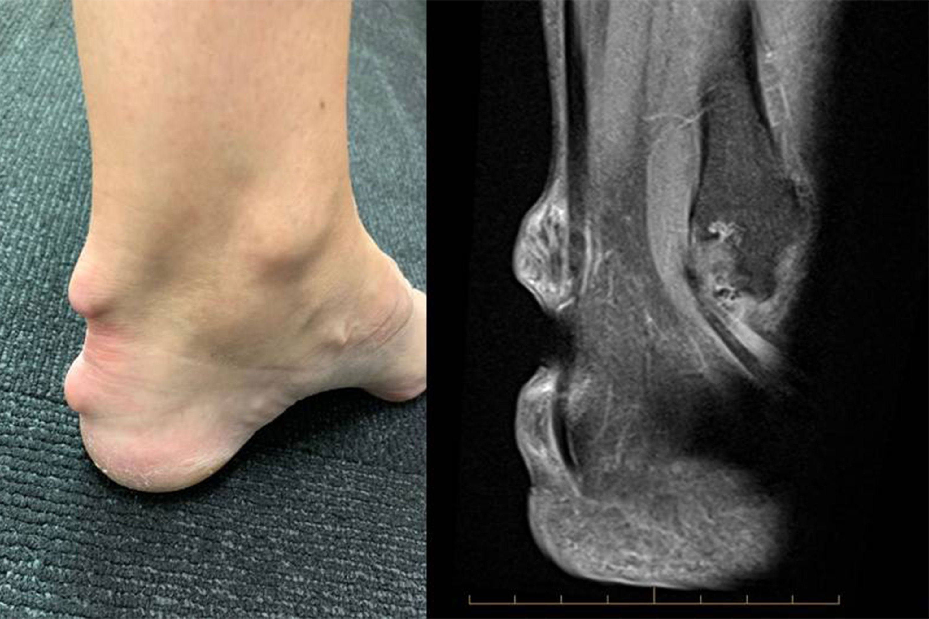 Rheumatoid Arthritis in the Ankle