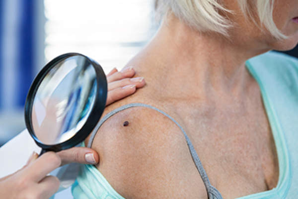 皮肤科医生检查女病人的摩尔放大镜。