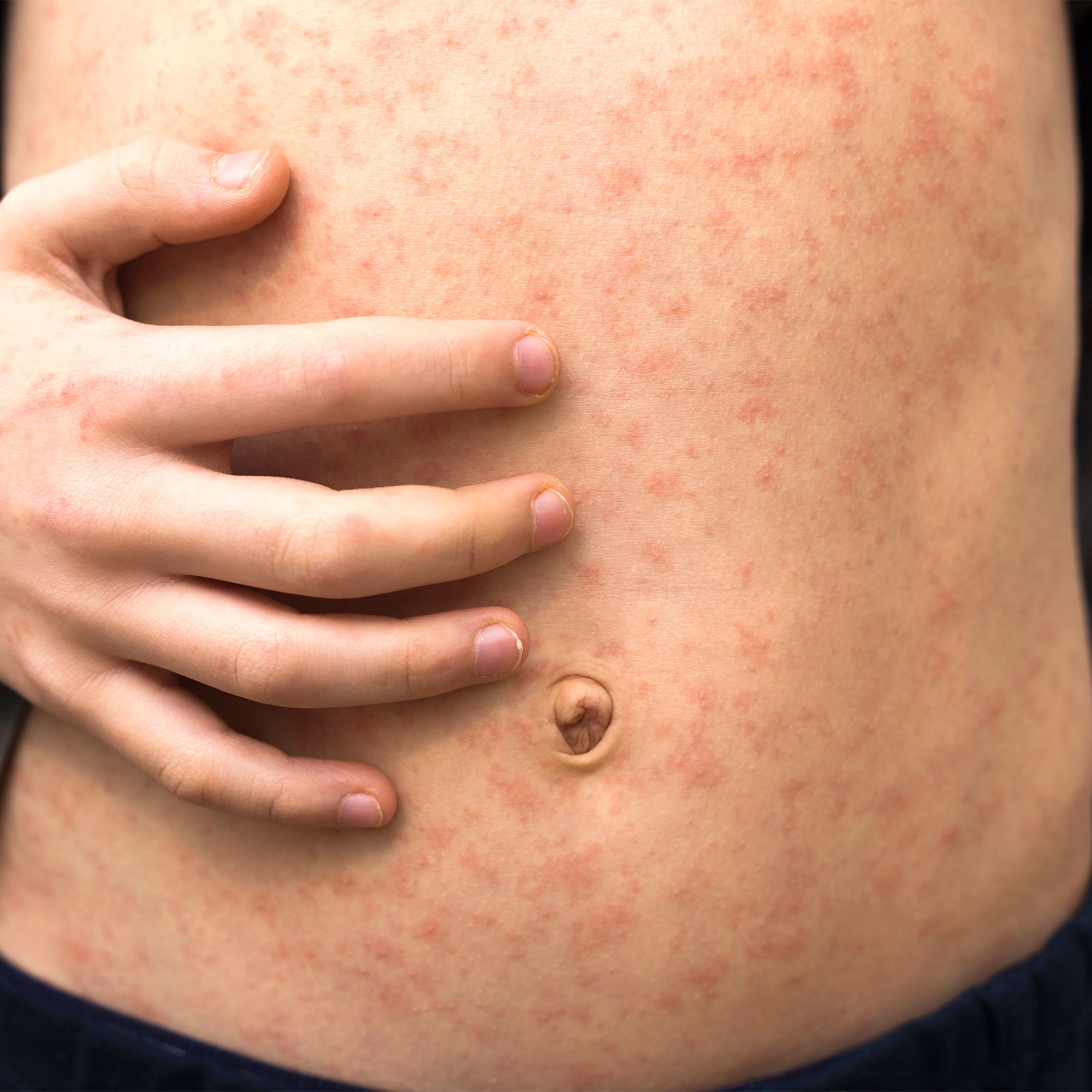 胃上的麻疹皮疹特写