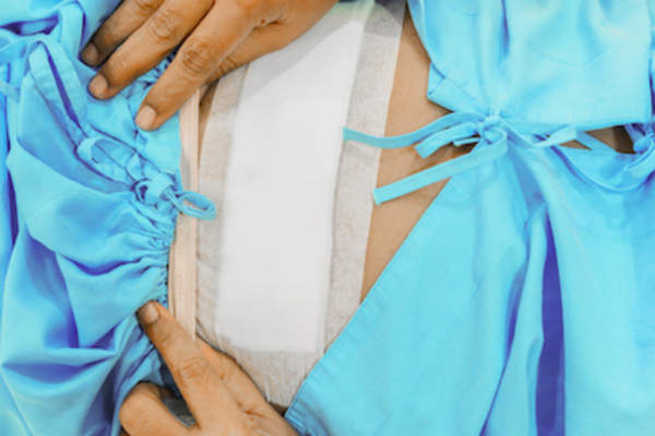 卵巢手术后妇女用绷带包扎。