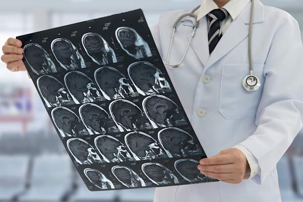 医生正在看中风病人的CT扫描。