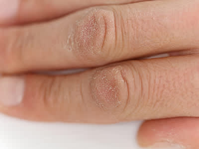 干性皮肤上的手指。