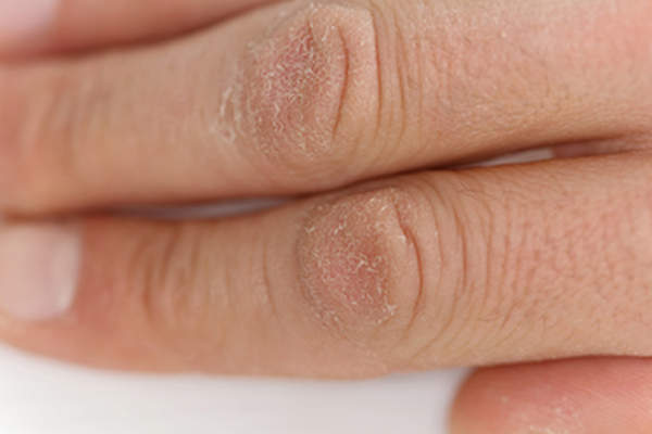 干性皮肤上的手指。